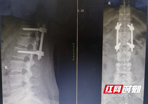 坐车时颠了一下41岁女子腰椎骨折了