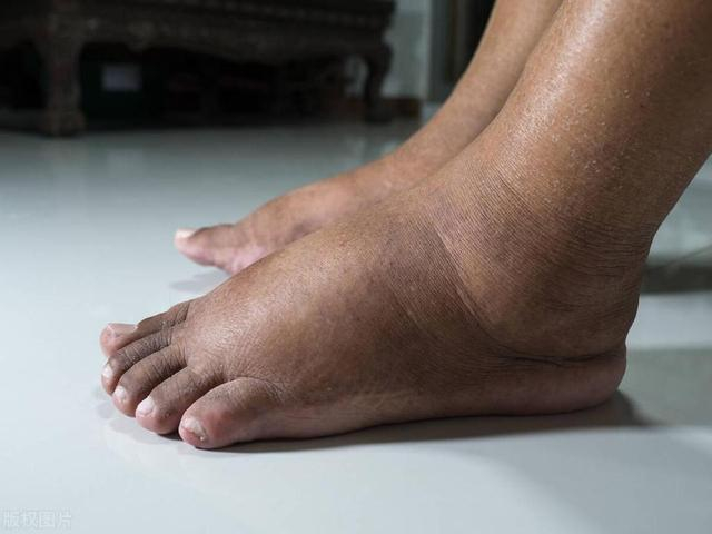 双腿反映全身病!7种易被忽视的腿部症状,可能是大病征兆|疾病|腿部肌肉|动脉硬化|静脉血栓|下肢静脉曲张_新浪新闻