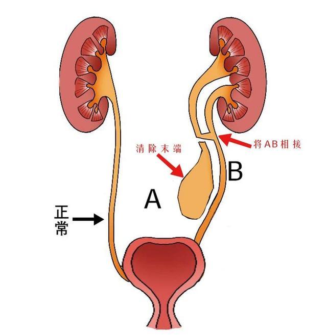 12岁女孩经常腹痛,一查竟然长了3根输尿管