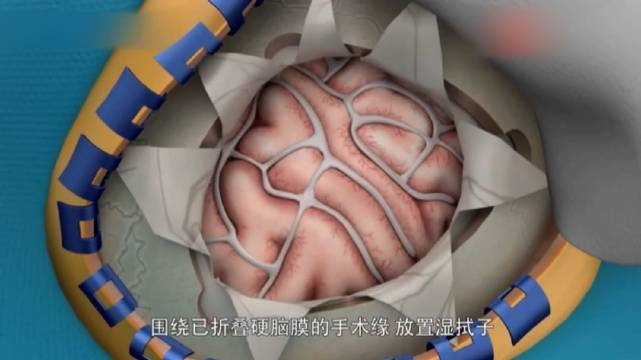 3d动画演示脑瘤摘除手术