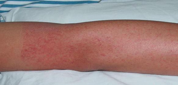 严重可致死!多国病例暴增|新冠肺炎_新浪新闻