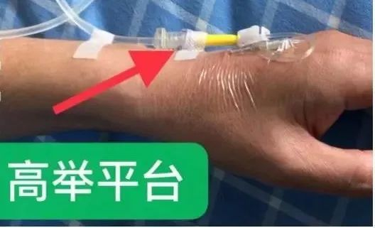 你知道留置针这样固定会有什么问题吗