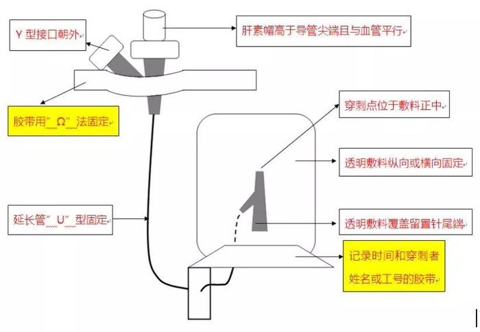 留置针正确固定步骤图图片