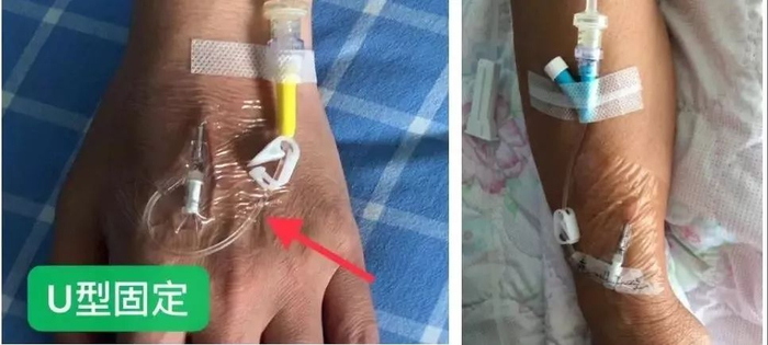 你知道留置针这样固定会有什么问题吗