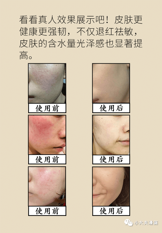 春季皮肤过敏,发红发痒长痘红血丝掉皮屑,怎么办?|皮肤过敏_新浪新闻