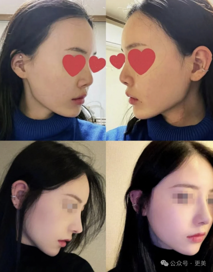 即便只是单纯鼻梁垫高项目,为了不打破上低下高的鼻部比例,鼻头也会