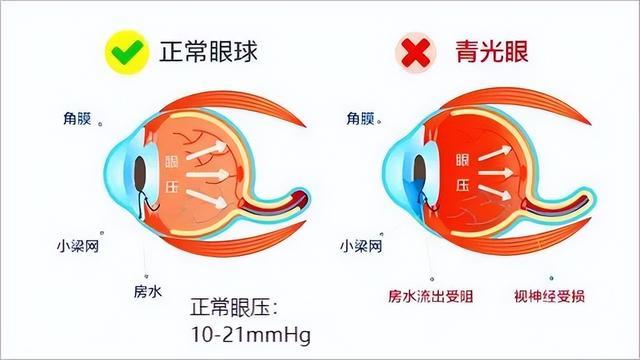 青光眼的人看到的图片图片