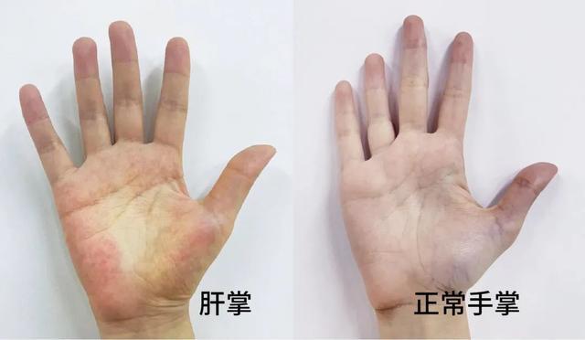 肝掌是怎么回事 新浪网