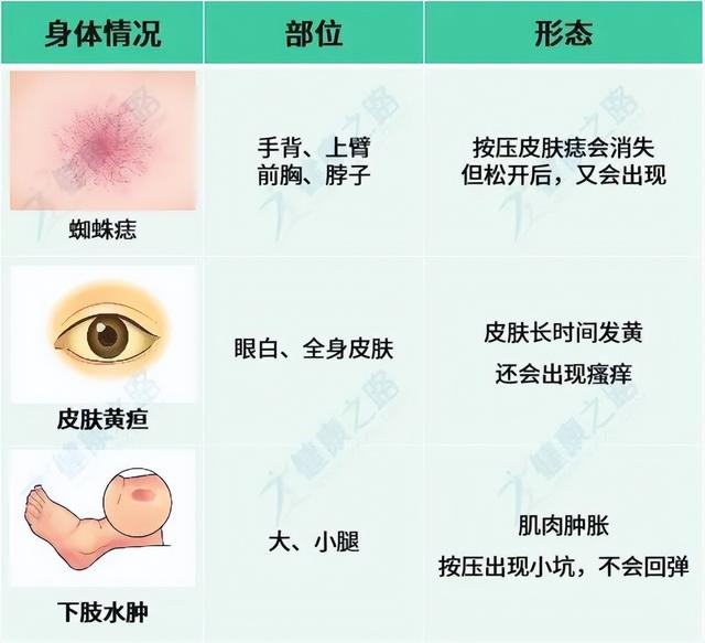 手上有这1个变化小心是肝癌预警男女都要警惕