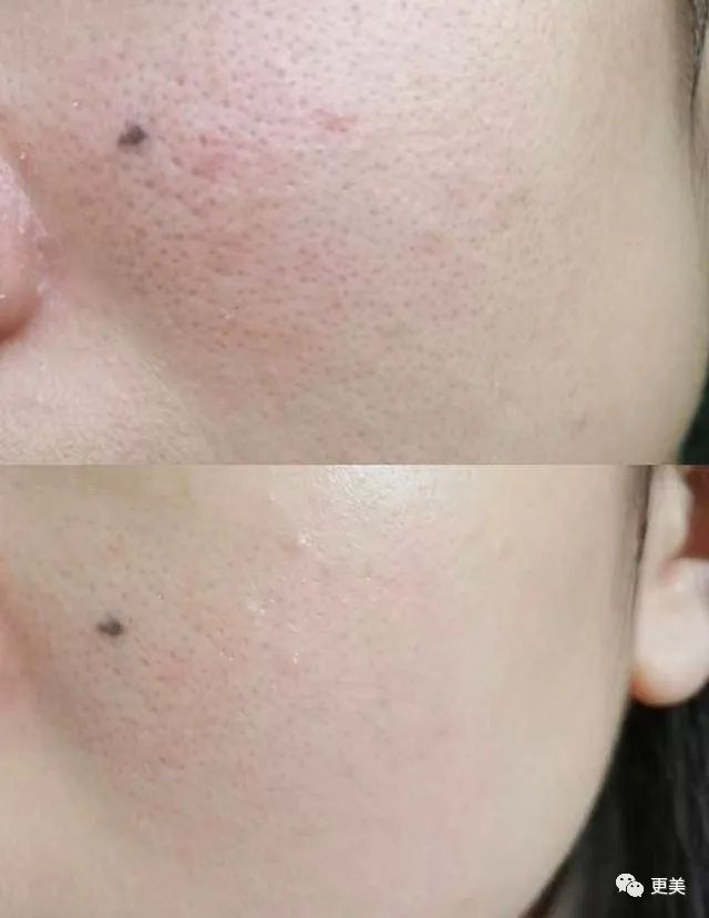 真当中国女明星是吃素的?|郑秀晶|微针|皮肤_新浪新闻