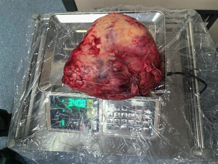 切下的肿瘤重达3.4公斤