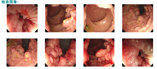 这种少见肿瘤要留意|肿瘤|痔疮|直肠_新浪新闻
