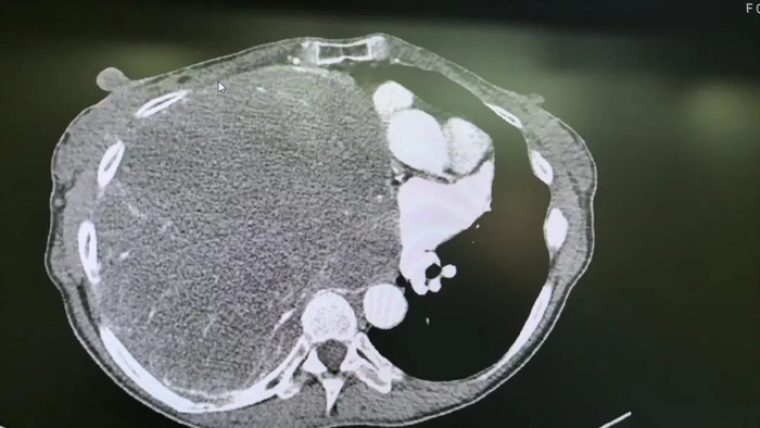 患者CT影像显示，巨大肿瘤占满右侧胸腔，并挤压到对侧胸腔 范军强供图