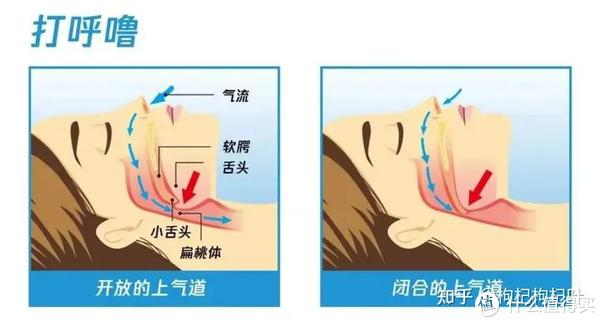 所以想解决打呼噜的问题,一定要先明确自己打呼噜的原因是什么.