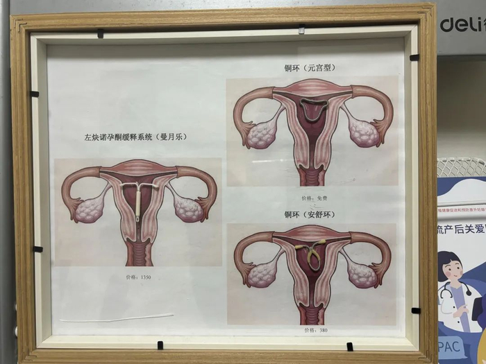 54岁的妈妈,"28岁"的节育环|子宫_新浪新闻