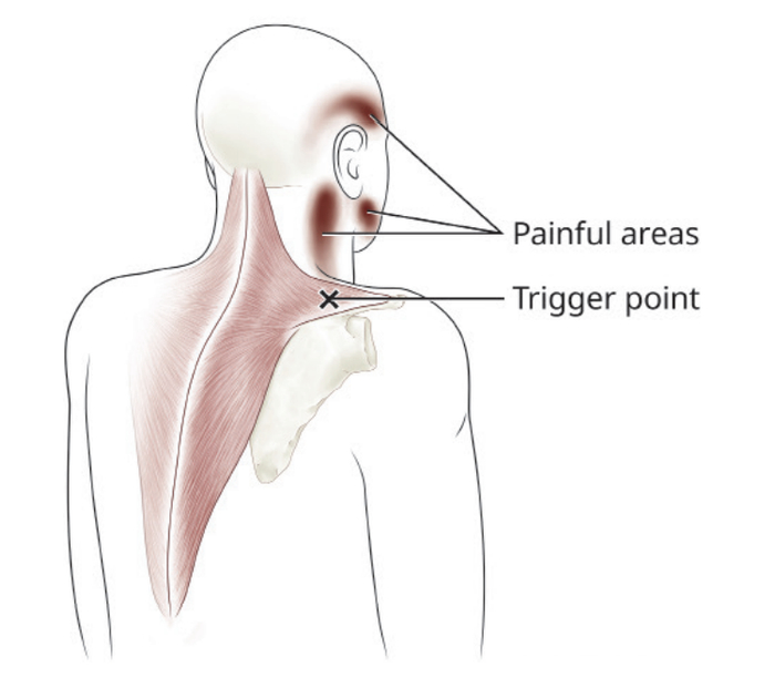 常见的头痛，有可能是斜方肌上侧的一个扳机点导致的 图片来源：网络