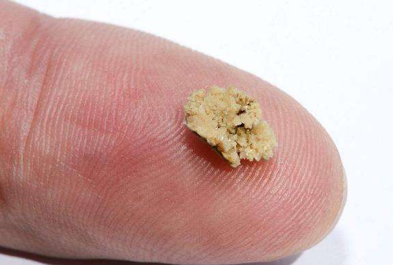 今日全宇宙最涨姿势的十张图|肾结石_新浪新闻