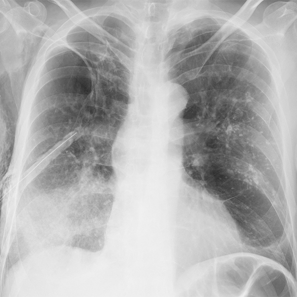 图1 a b cq:以下哪项是最可能的诊断?a.社区获得性肺炎b.肺不张局部c.