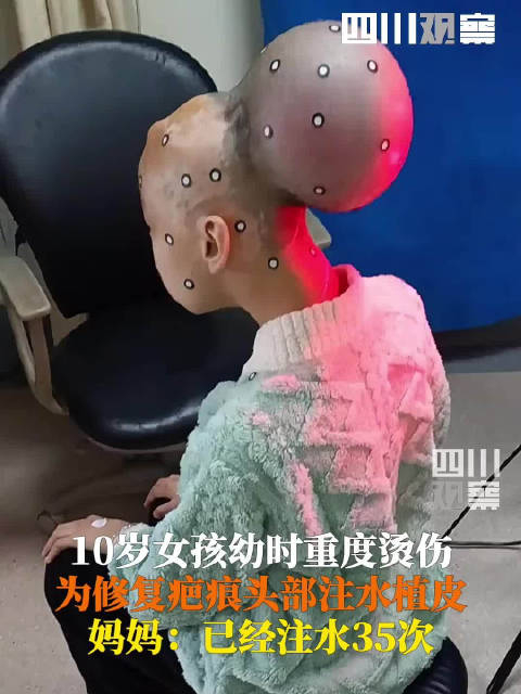 愿早日康复烫伤女孩为修复疤痕头部35次注水