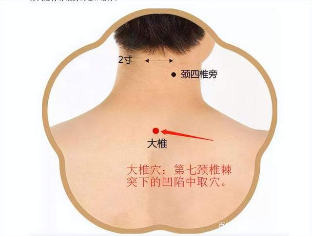 颈椎病坚持艾灸调理还是不错的