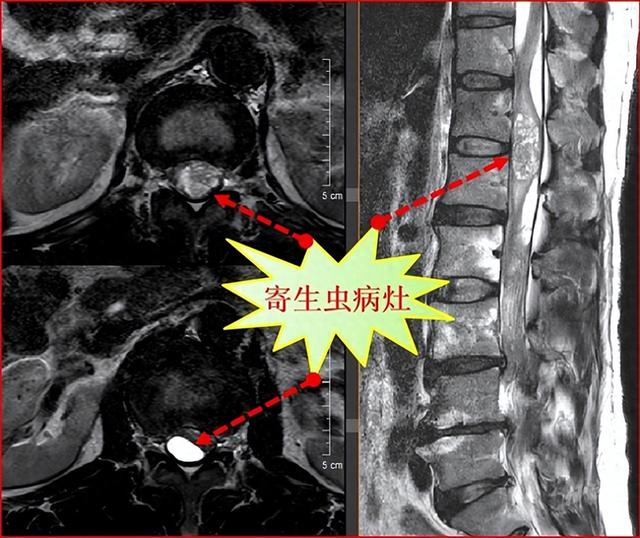 竟是因15年前的一顿"野路子"偏方|南方医科大学|怪病|裂头蚴_新浪新闻