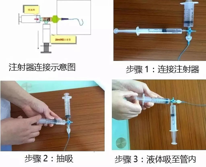 picc堵管再通方法(图解版)|血栓|注射器_新浪新闻