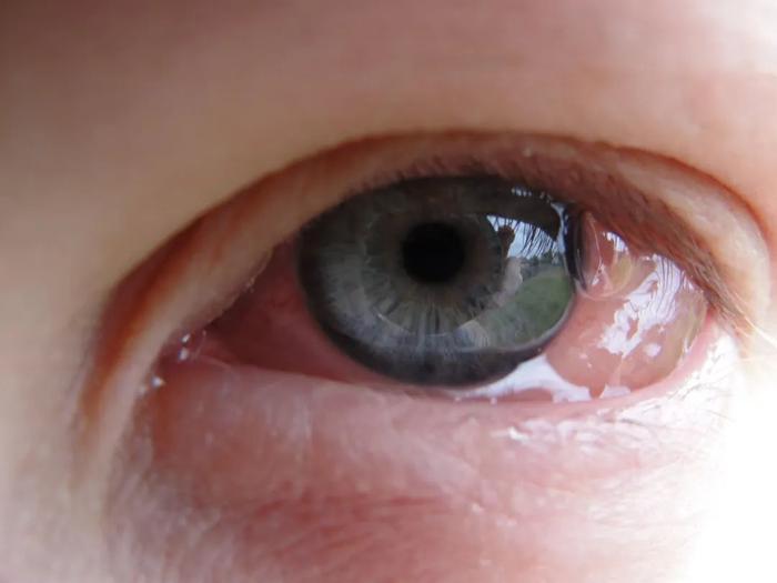 眼睛瘙痒,刺痛,是过敏性结膜炎吗?