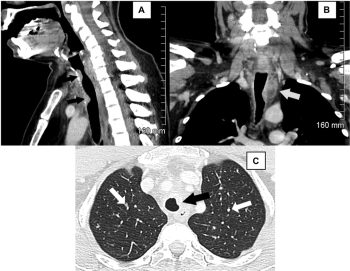 诊断肿瘤,放疗7次,最终竟是误诊……|恶性肿瘤|ct扫描|胸部_新浪新闻