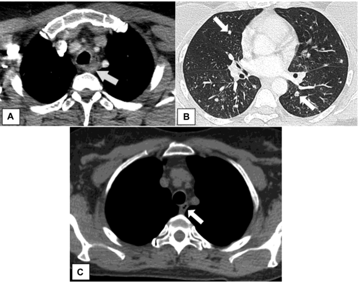 诊断肿瘤,放疗7次,最终竟是误诊……|恶性肿瘤|ct扫描|胸部_新浪新闻
