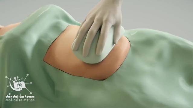 看了这个你还会抽脂吗,抽脂手术过程和危害,3d演示