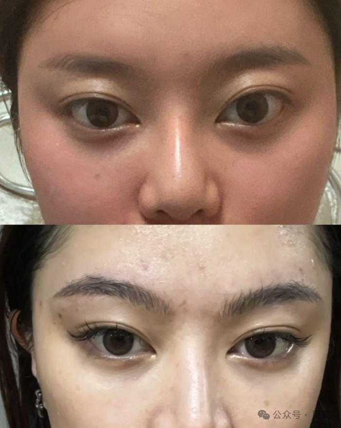 菱形脸网红爆改美成fbb她光鼻子就整了3次