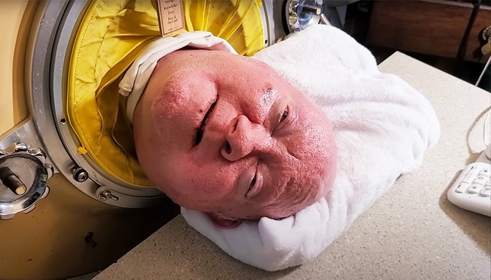 靠"铁肺"生活72年,美国小儿麻痹症幸存者保罗·亚历山大去世