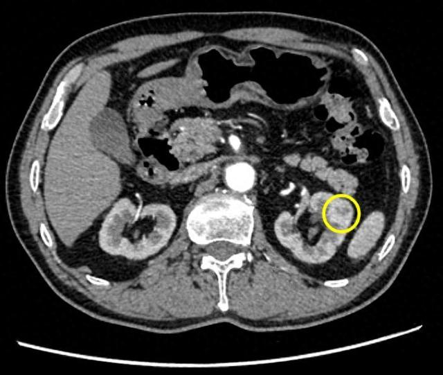 陈老伯的CT检查情况。仁济医院供图