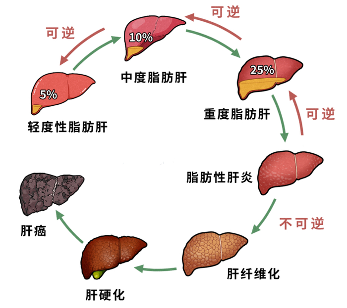 研究发现越早得脂肪肝越容易患癌日常做好4件事或能逆转脂肪肝