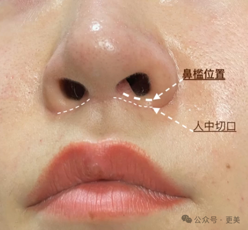鼻槛总共就是一条线的面积,开刀再愈合,就容易失去