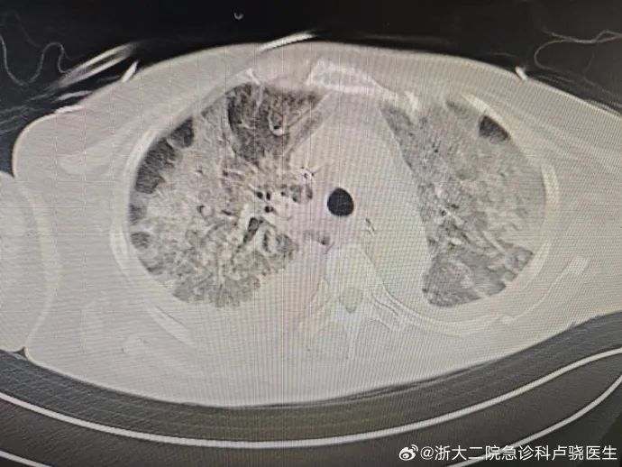 从没阳过的人要当心了!|新冠肺炎_新浪新闻