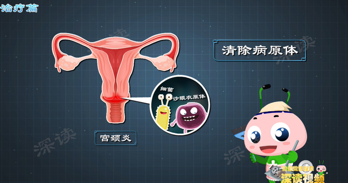 宫颈炎没感觉检查竟已是癌症宫颈有没有炎症看看白带就知道