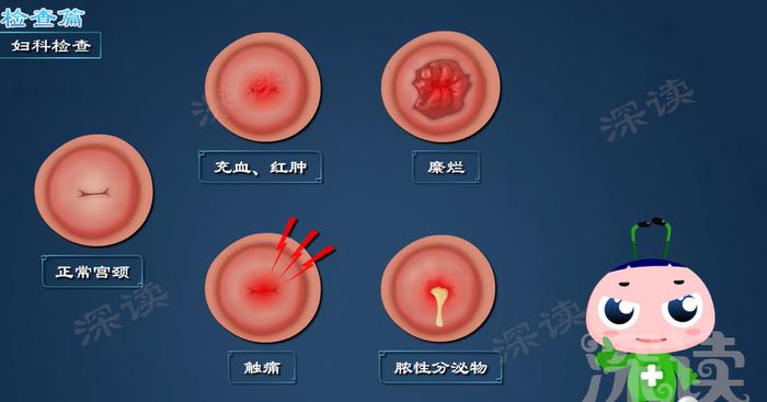 检查竟已是癌症?宫颈有没有炎症,看看白带就知道!