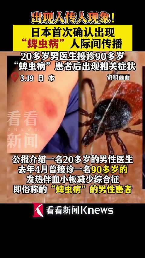20多岁男医生接诊后被传染日本首次确认出现蜱虫病人传人
