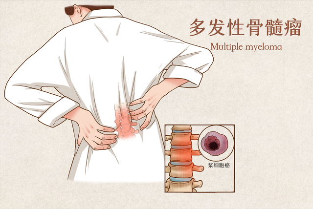 腰肌劳损|腰痛_新浪新闻