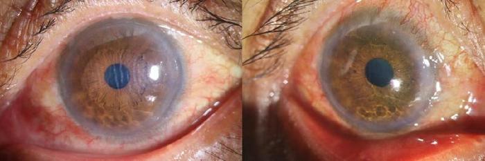 3,上下眼睑出现了轻度的红肿症状,同时球结膜和睑结膜也呈现出充血