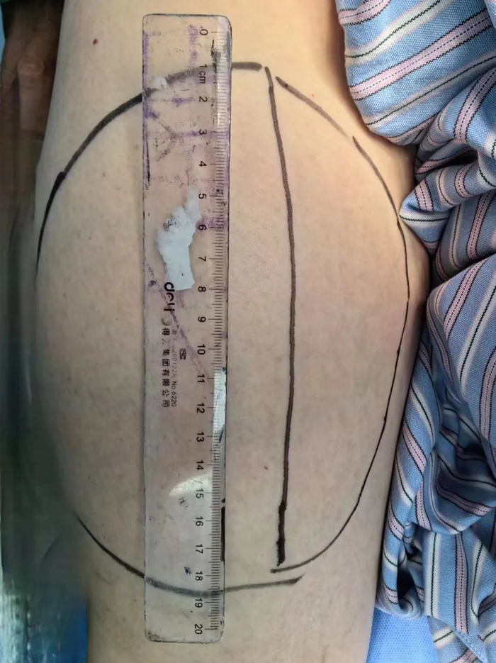 多学科联合巨型肿瘤精准切除宝山这家医院让患者恢复自由奔跑