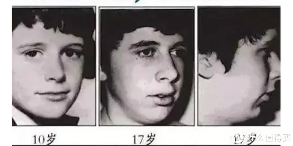 鼻息肉,腺样体肥大,中耳炎等,小花花的腺样体肥大就和过敏性鼻炎息息