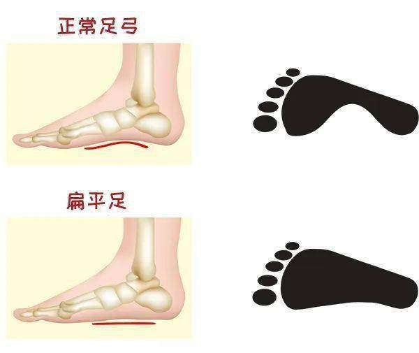 这种拖鞋,可能正在毁掉你的脚……|足部|鞋底|足弓_新浪新闻
