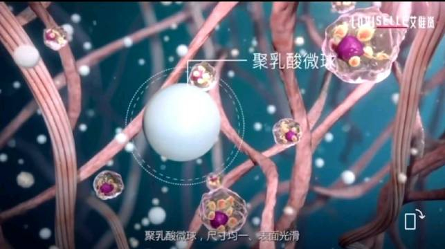 艾维岚是将微球降解成乳酸,上调脯氨酸羟化酶及转化生长因子tgf-β