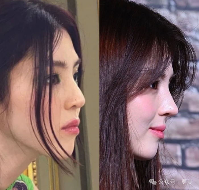 韩素希割双眼皮前就是典型的韩式肿眼泡啊