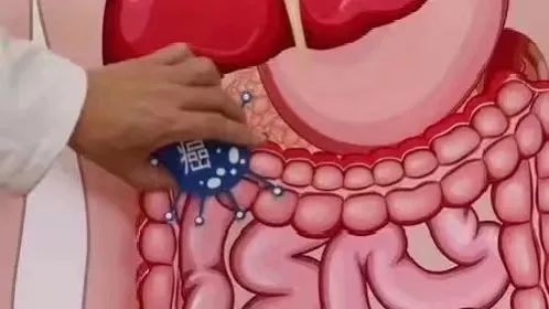以为是拉肚子结果是不死癌一旦确诊终身为伴我国患病率逐步上升