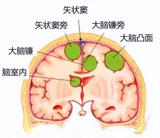 脑膜瘤可以火针调理