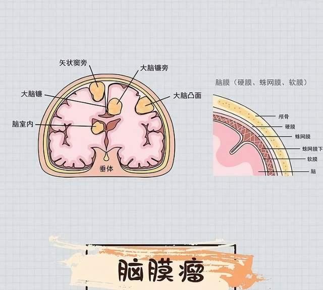 脑膜瘤可以火针调理