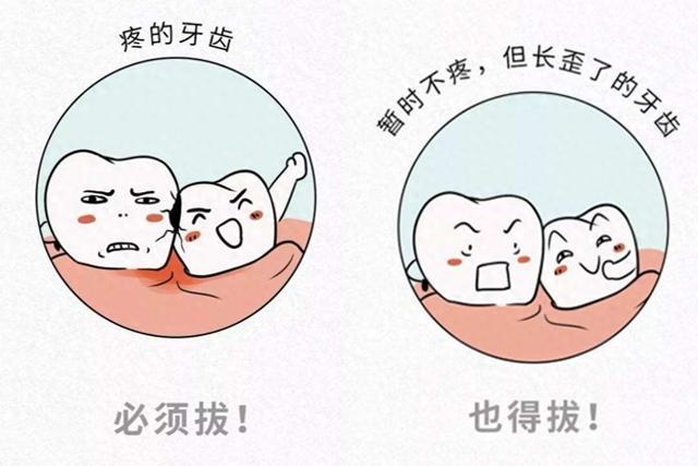 拔除智齿是预防智齿冠周炎最彻底的方法,但并不是所有智齿部一定要拔